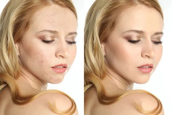 high end skin retouching