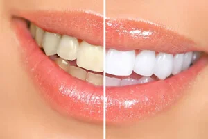 Teeth Whitening